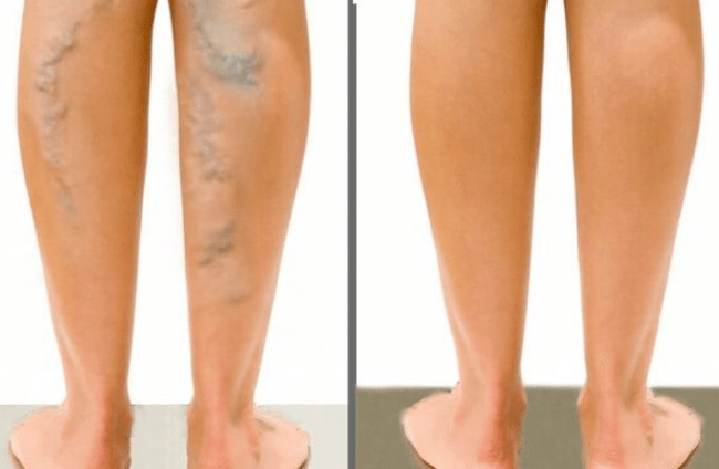 Varicose veins before and after surgery