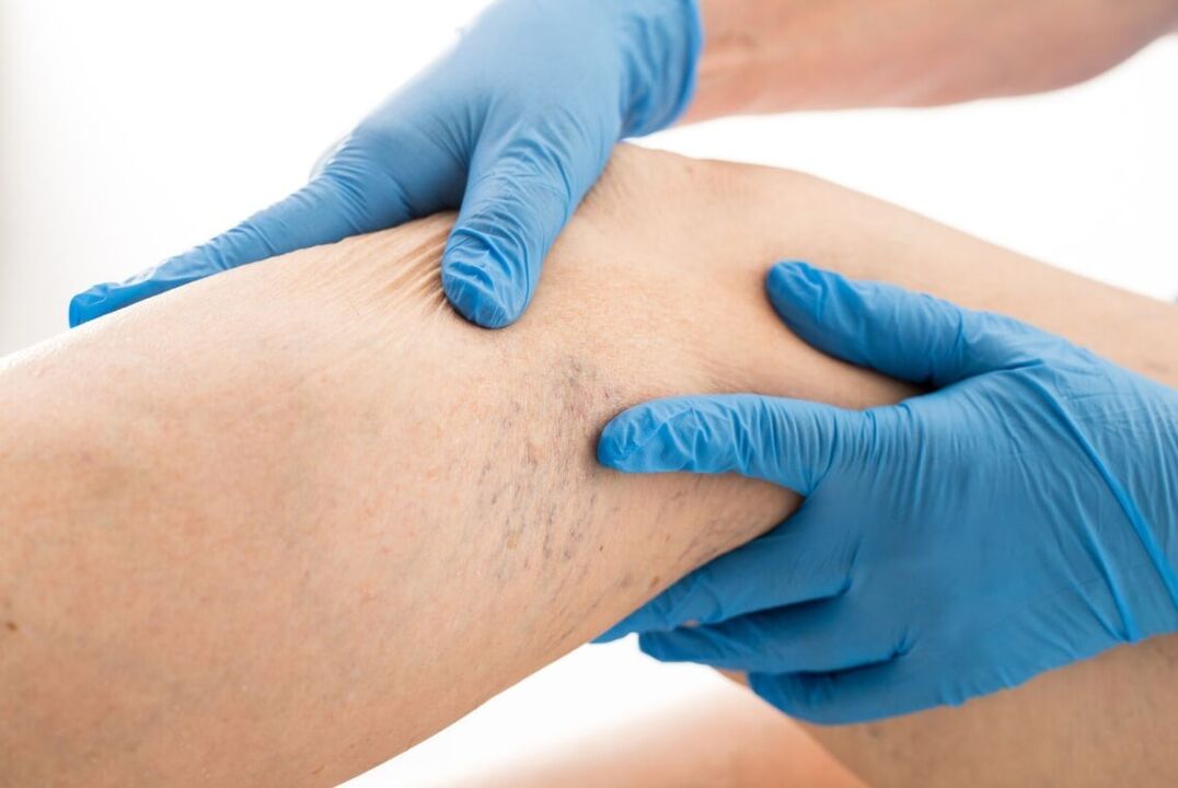 Clinical cartin varicose disease