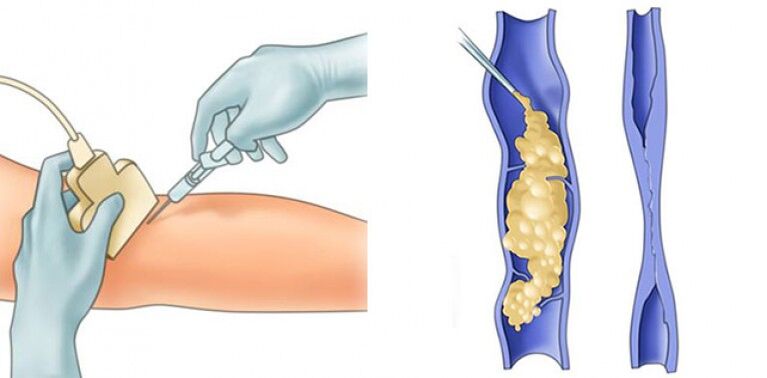 Varicose vein treatment