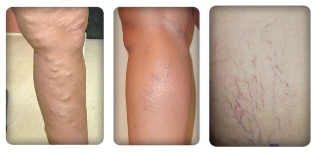 Varicose vein stage