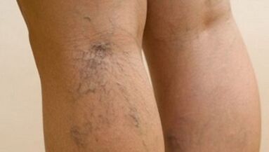 The cause of varicose veins