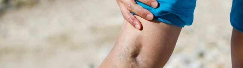 varicose veins in the legs