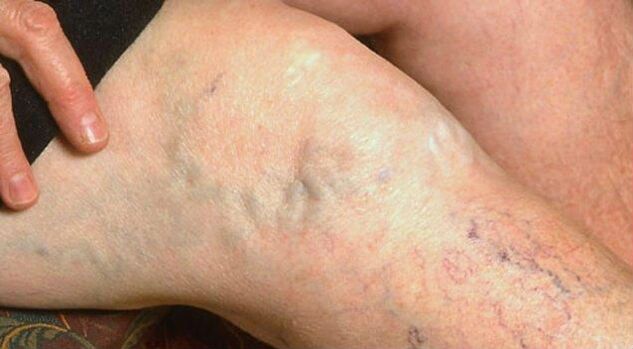 Symptoms of varicose veins that can be seen in the legs