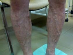 Varicose veins in the legs