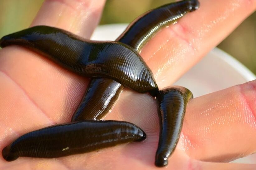 Leeches will help in the fight against varicose veins