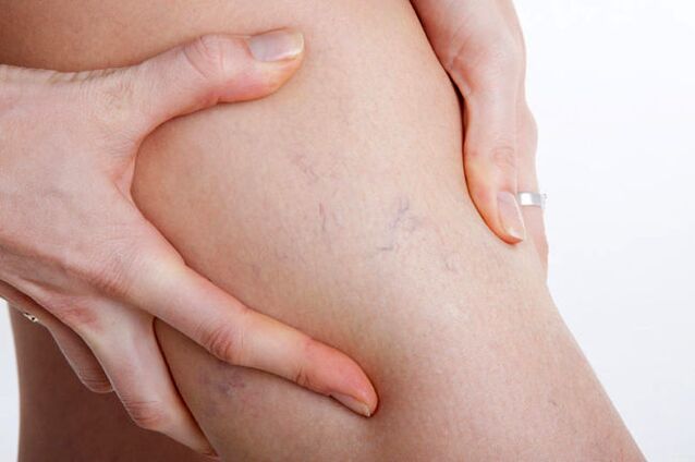 The first appearance of varicose veins on the legs